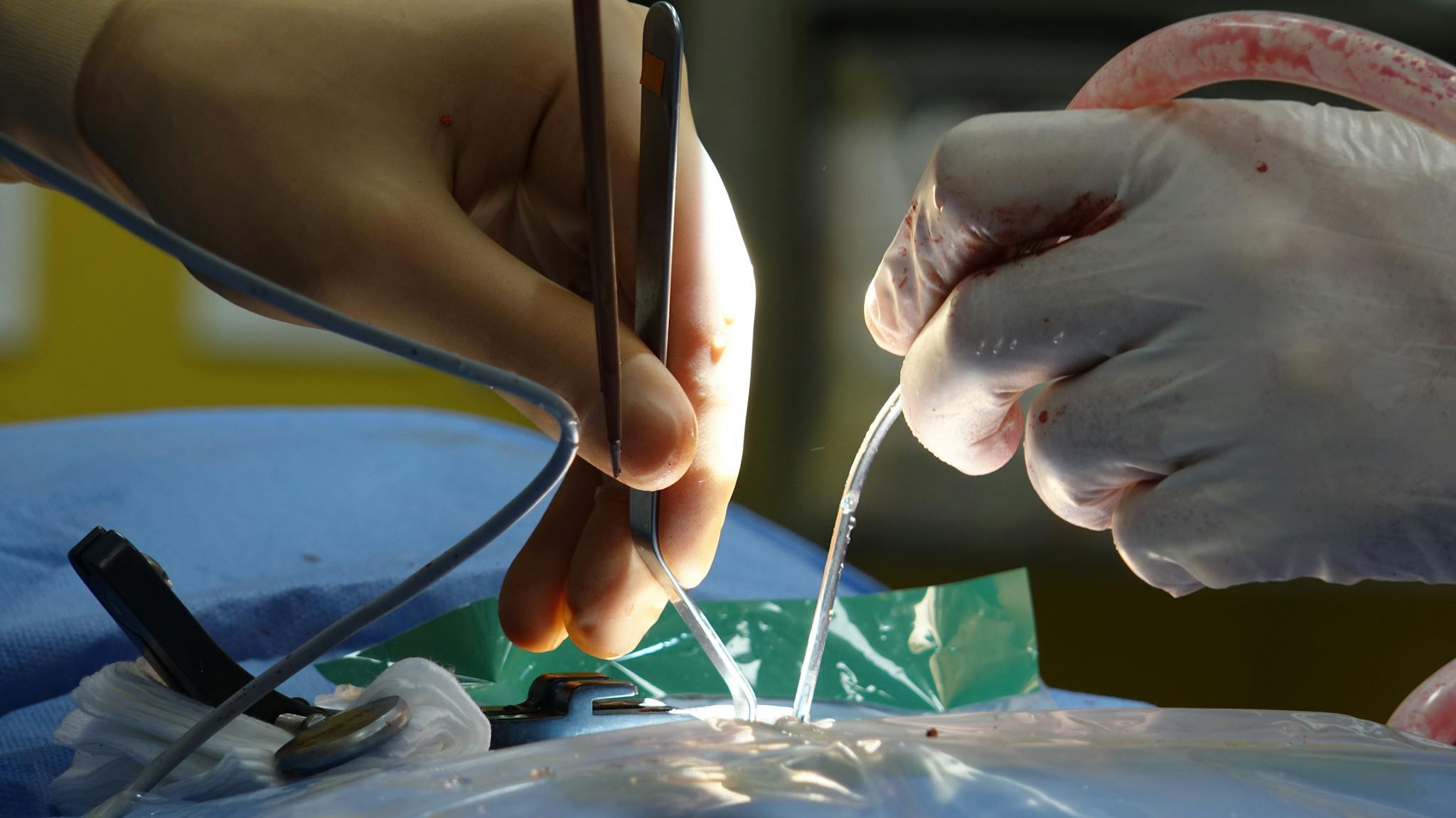 Intricate surgical procedure with surgeons using tools in a sterile operating room.